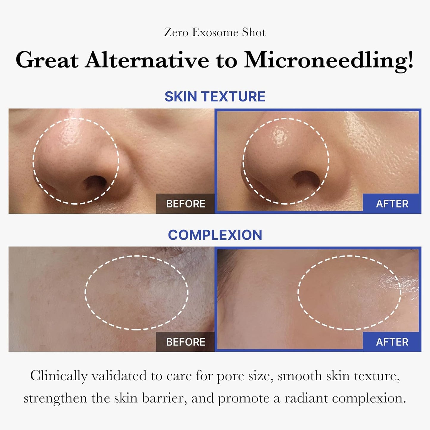 [MEDICUBE] Affordable Trio for Pore & Texture Care: Zero Pore Pads 2.0 and Zero Exosome Shot 7,500 PPM Spicule Facial Serum